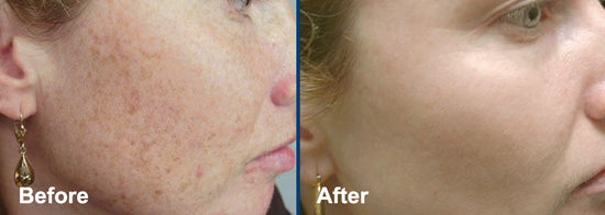 Accent on Beauty - IPL (Intense Pulsed Light) Skin Renewal