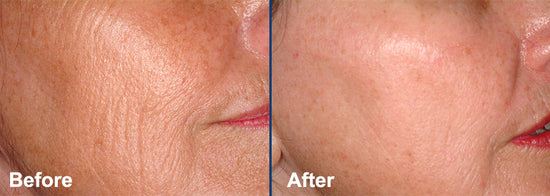 Accent on Beauty - Fractional Laser