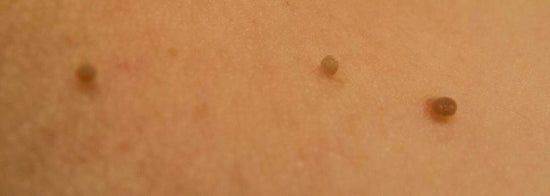 Accent on Beauty - Skin Tag Removal